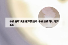牛皮癣可以用抹芦荟胶吗 牛皮肤癣可以用芦荟吗