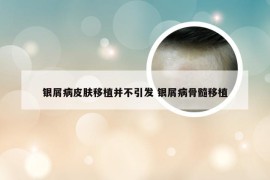 银屑病皮肤移植并不引发 银屑病骨髓移植