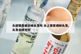 头部银屑病会掉头发吗 头上银屑病掉头发,头发会掉光吗