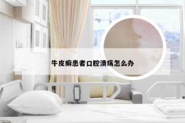 牛皮癣患者口腔溃疡怎么办