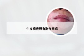 牛皮癣光照有副作用吗