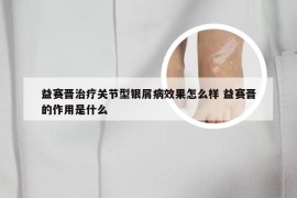 益赛晋治疗关节型银屑病效果怎么样 益赛晋的作用是什么