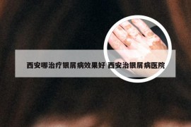 西安哪治疗银屑病效果好 西安治银屑病医院