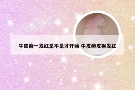 牛皮癣一发红是不是才开始 牛皮癣皮损发红