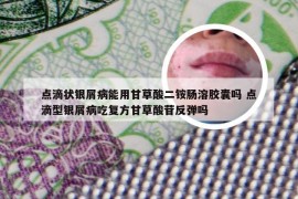 点滴状银屑病能用甘草酸二铵肠溶胶囊吗 点滴型银屑病吃复方甘草酸苷反弹吗