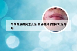 早期白点癫风怎么治 白点癫风早期可以治疗吗