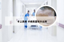 手上真癣 手癣真菌长什么样