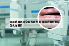 银屑病消退后变白怎么办 银屑病消退后变白怎么办图片