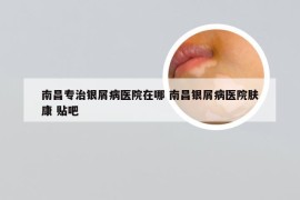 南昌专治银屑病医院在哪 南昌银屑病医院肤康 贴吧