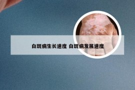 白斑病生长速度 白斑病发展速度