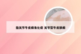 指关节牛皮癣角化症 关节型牛皮肤癣