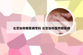 北京协和银屑病专科 北京协和医院银屑病