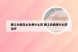 脚上长癣怎么办用什么药 脚上长癣用什么药治疗