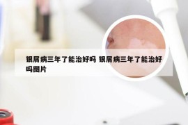 银屑病三年了能治好吗 银屑病三年了能治好吗图片