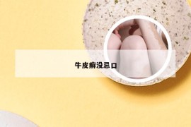 牛皮癣没忌口