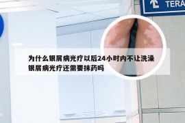 为什么银屑病光疗以后24小时内不让洗澡 银屑病光疗还需要抹药吗