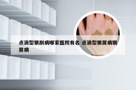 点滴型银削病哪家医院有名 点滴型银屑病银屑病