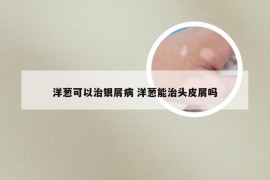 洋葱可以治银屑病 洋葱能治头皮屑吗
