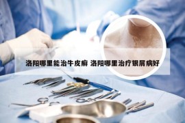 洛阳哪里能治牛皮癣 洛阳哪里治疗银屑病好