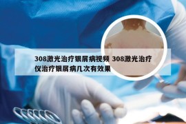308激光治疗银屑病视频 308激光治疗仪治疗银屑病几次有效果