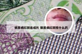 银屑病红斑连成片 银屑病红斑擦什么药
