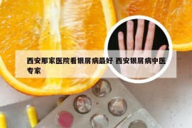 西安那家医院看银屑病最好 西安银屑病中医专家