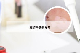 潍坊牛皮癣光疗