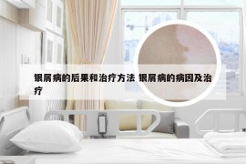 银屑病的后果和治疗方法 银屑病的病因及治疗