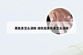 黑色素怎么消除 烧伤后黑色素怎么消除