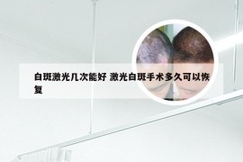 白斑激光几次能好 激光白斑手术多久可以恢复