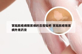 掌跖脓疱病银屑病的百度贴吧 掌跖脓疱银屑病外用药膏