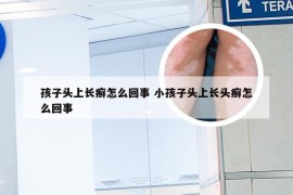 孩子头上长癣怎么回事 小孩子头上长头癣怎么回事