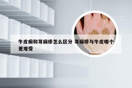 牛皮癣和荨麻疹怎么区分 荨麻疹与牛皮哪个更难受