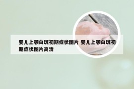 婴儿上颚白斑初期症状图片 婴儿上颚白斑初期症状图片高清