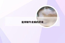 能抑制牛皮癣的药膏