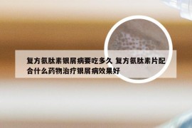复方氨肽素银屑病要吃多久 复方氨肽素片配合什么药物治疗银屑病效果好