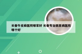 长春牛皮癣医院哪家好 长春专治银屑病医院哪个好