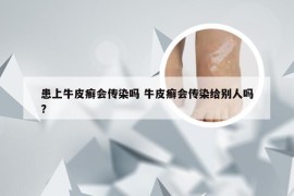患上牛皮癣会传染吗 牛皮癣会传染给别人吗?