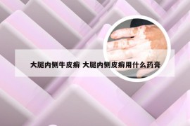 大腿内侧牛皮癣 大腿内侧皮癣用什么药膏