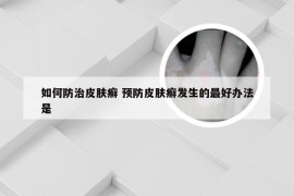 如何防治皮肤癣 预防皮肤癣发生的最好办法是