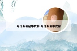 为什么会起牛皮藓 为什么会牛皮廨