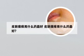 皮肤瘙痒用什么药最好 皮肤瘙痒用什么药最好?