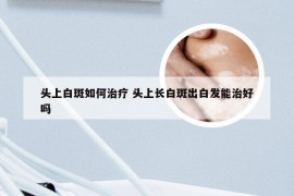 头上白斑如何治疗 头上长白斑出白发能治好吗