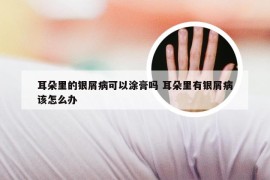 耳朵里的银屑病可以涂膏吗 耳朵里有银屑病该怎么办
