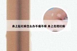 身上起红癣怎么办不痛不痒 身上出现红癣