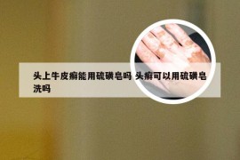 头上牛皮癣能用硫磺皂吗 头癣可以用硫磺皂洗吗
