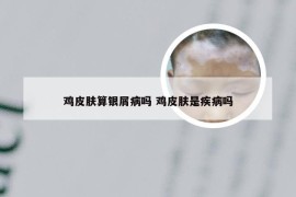 鸡皮肤算银屑病吗 鸡皮肤是疾病吗