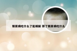 银屑病吃什么了能缓解 得了银屑病吃什么