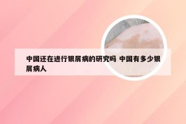 中国还在进行银屑病的研究吗 中国有多少银屑病人