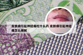 皮肤病引起神经痛吃什么药 皮肤病引起神经痛怎么缓解